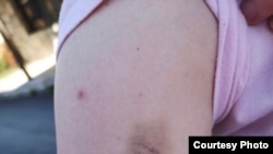 Povreda na ruci Kolašinke Milice Živković. "Uprkos tome što sam imala hematom, izvještaj ljekara o povredi, sudija je njega predstavio kao žrtvu", kazala je Milica.