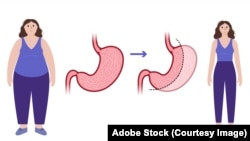 În imagine se poate observa o operație bariatrică în care pacientului i se îndepărtează două treimi din stomac. Această intervenție chirurgicală îi limitează cantitatea de alimente pe care o poate consuma și îl ajută să piardă în greutate.