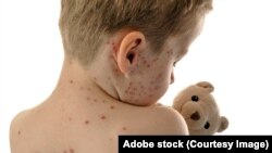Kid measles