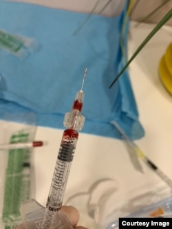 Një shiringë e cila gjatë procesit të aplikimit të botoksit ka hasur në kapilarë.