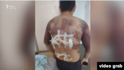 На этом фото, облетевшем социальные сети в январе, запечатлен житель города Талдыкоргана Азамат Батырбаев с множеством гематом на руках и спине, а также со следами от ожогов. Родственники и земляки Батырбаева заявили, что после задержания его избивали, тело прижигали утюгом