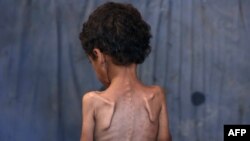 Një dyvjeçar palestinez i dobësuar për shkak të mungesës së ushqimeve dhe kequshqyerjes. 