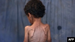 Yazan, 2-vjeçari palestinez, që vuan nga kequshqyerja. Qyteti i Gazës, 23 korrik 2025. 