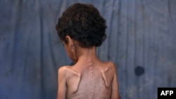 Palestinsko dijete pati od neuhranjenosti.