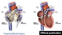 Вештачко срце - илустрација