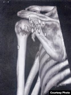 Снимок плеча без сустава Ивана Топчия