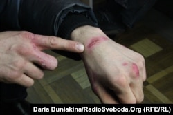 Побої на руках Андрія Лисенка