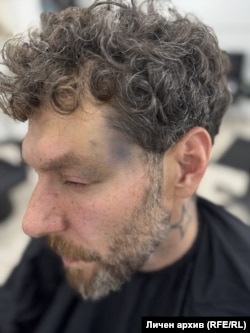 Следите от побоя по лицето на Сапунджиев