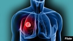 Илустративна фотографија - малигно заболување на бели дробови.