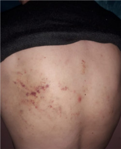 Биржан Толеубеков показывает ссадины на спине.