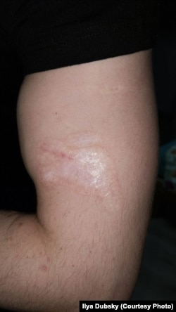 Dubskinin sol əlindəki yara aydın görünür.