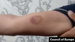 Сирожиддин Курбанов показывает синяк на руке после побоев сотрудниками милиции