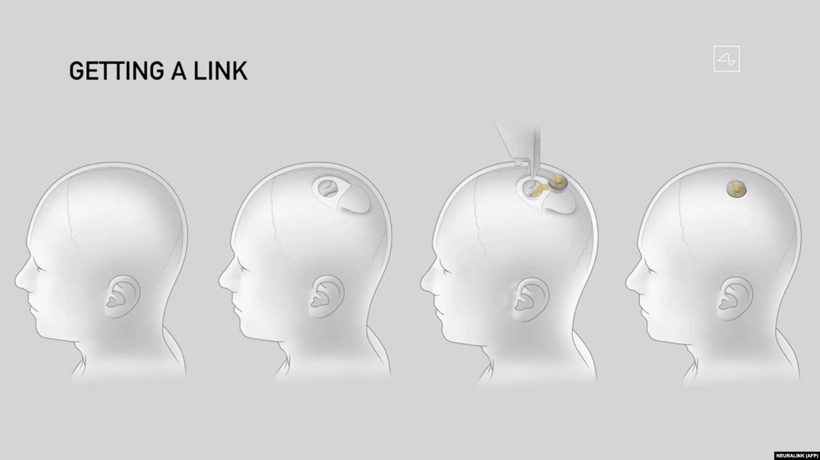 Ilustracija koraka implantacije Neuralink uređaja tokom prezentacije 28. avgusta 2020. 