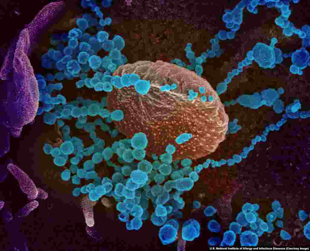 Agjentët infektues të koronavirusit që dalin nga qelizat njerëzore. Të gjitha fotografitë në këtë galeri janë ngjyrosur duke përdorur aplikacione si Photoshop, apo të ngjashme.