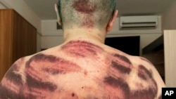 Elena Milașina, jurnalistă la Novaia gazeta, are spatele plin de vânătăi după ce a primit îngrijiri medicale la Moscova, pe 5 iulie. Ea spune că a fost bătută cu țevi de plastic de 10-15 atacatori.